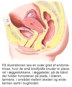 endometriose